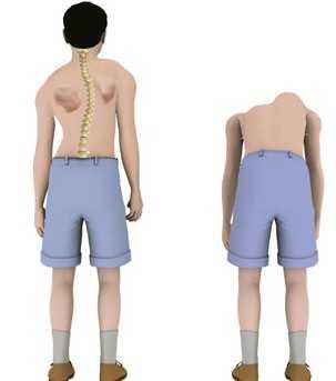 脊柱侧弯有哪些症状呢？